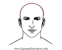 Którą deformację głowy przedstawiono na rysunku?