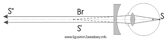 Rysunek przedstawia korekcję oka