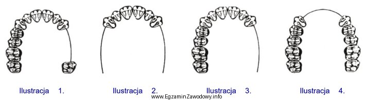 Która ilustracja przedstawia schemat III klasy braków zę