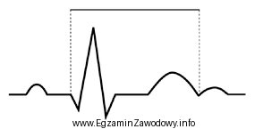 Na wykresie EKG zaznaczono