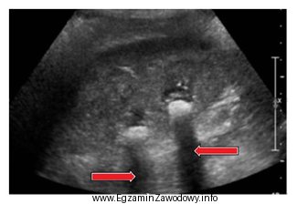 Który artefakt wskazano strzałkami na obrazie USG nerki?