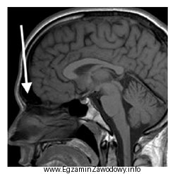 Na obrazie rezonansu magnetycznego głowy strzałką wskazano zatokę
