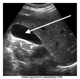 Na obrazie ultrasonograficznym jamy brzusznej strzałką wskazano