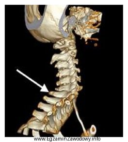 Na obrazie TK kręgosłupa strzałką zaznaczono wyrostek