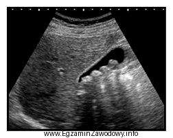 Którą strukturę anatomiczną uwidoczniono na zamieszczonym obrazie USG?