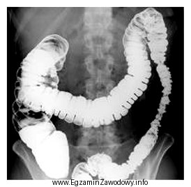 Przedstawiony obraz radiologiczny został zarejestrowany podczas badania jelita