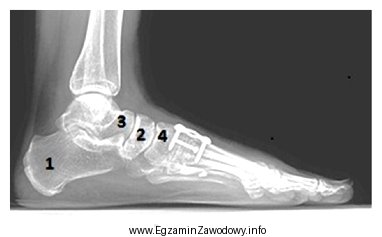 Na zdjęciu RTG lewej stopy kość łó