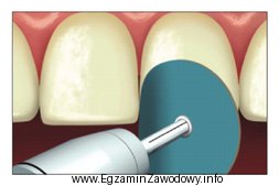 Zdjęcie przedstawia nadawanie kształtu i polerowanie zęba 