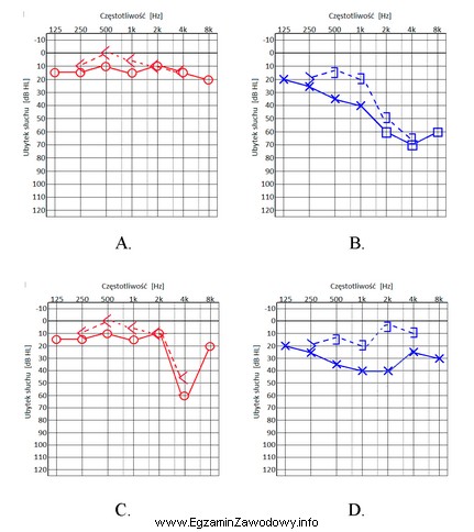 Który audiogram jest charakterystyczny dla urazu akustycznego?