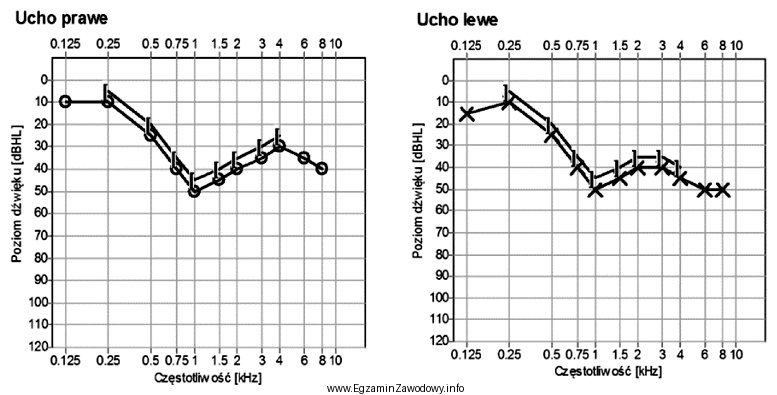 Zamieszczony audiogram przedstawia wynik badania pacjenta