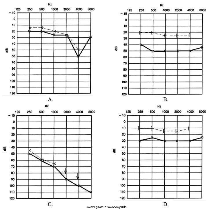 Który audiogram dotyczy pohałasowego ubytku słuchu?