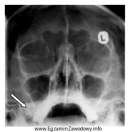 Na radiogramie czaszki strzałką zaznaczono