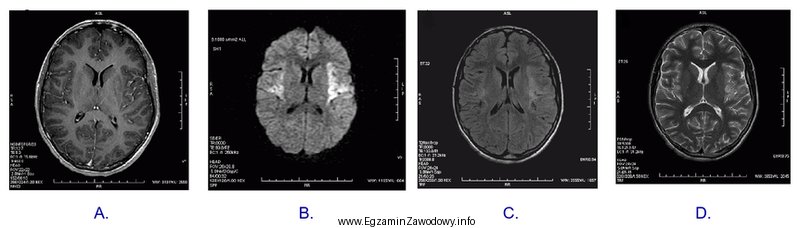 Który obraz MR mózgu został wykonany w sekwencji 
