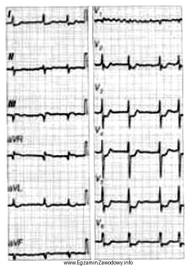 Na elektrokardiogramie uwidoczniono