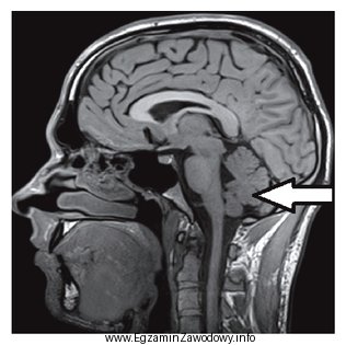 Którą strukturę anatomiczną oznaczono strzałką na obrazie rezonansu 