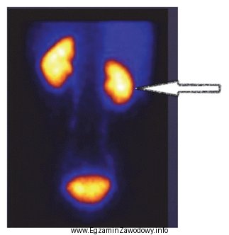 Na scyntygramie strzałką oznaczono