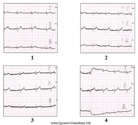 Który elektrokardiogram jest poprawny technicznie?