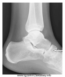 Na radiogramie strzałką oznaczono