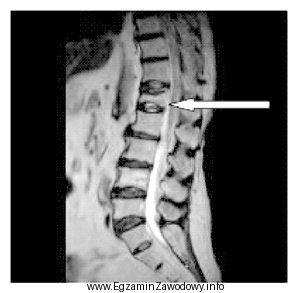Na obrazie rezonansu magnetycznego strzałką oznaczono patologiczny kręg