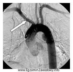 Na obrazie cyfrowej angiografii subtrakcyjnej strzałką zaznaczono