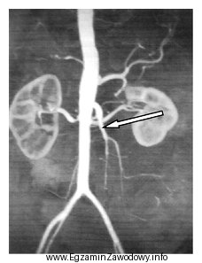 Którą tętnicę zaznaczono strzałką na obrazie MR?