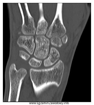 Na obrazie TK nadgarstka uwidocznione jest złamanie kości