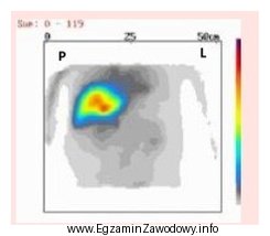 Który narząd został uwidoczniony na przedstawionym obrazie scyntygraficznym?