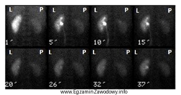 Na zarejestrowanych obrazach badania renoscyntygraficznego widać, że prawa nerka 