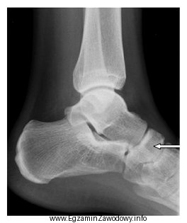 Na radiogramie strzałką oznaczono